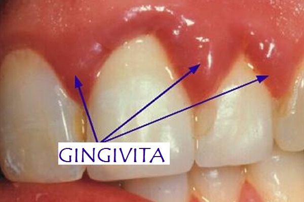 Ce cauzeaza gingivita si inflamarea gingiilor